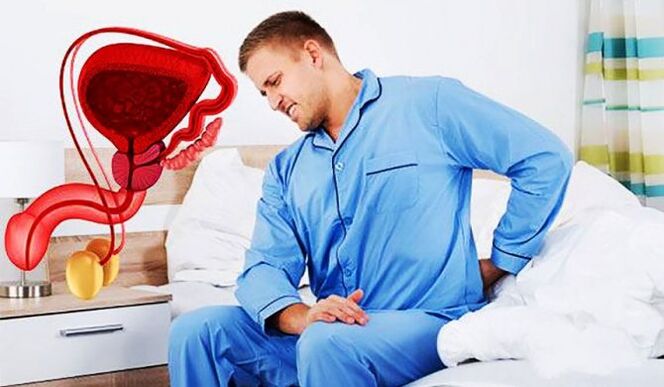 douleur dans le bas du dos due à une prostatite