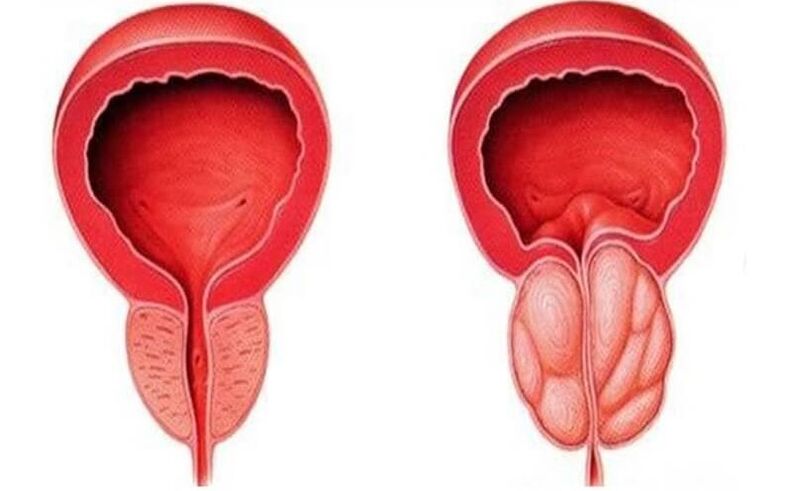 prostate saine et enflammée avec prostatite