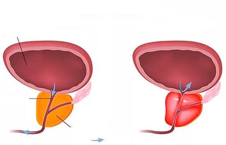prostate normale et enflammée