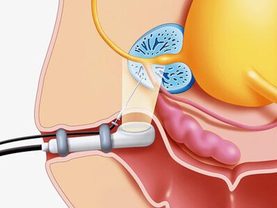 Biopsie par ponction de la prostate