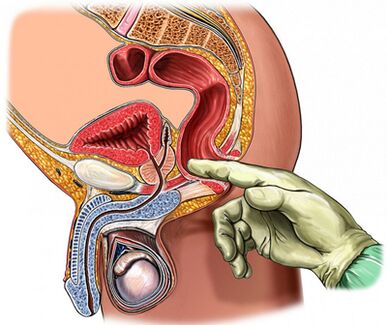 Examen de la prostate du doigt