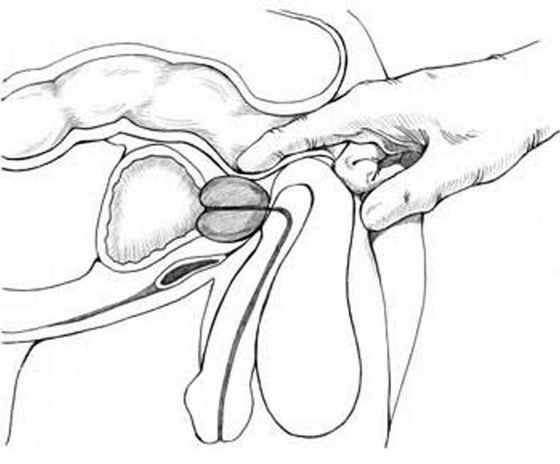 massage de la prostate pour prostatite chronique