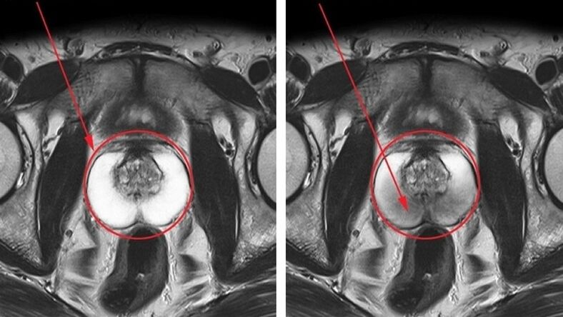 une prostate saine et enflammée avec une prostatite chronique