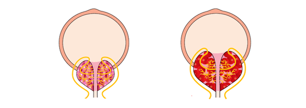 prostate saine et enflammée avec prostatite